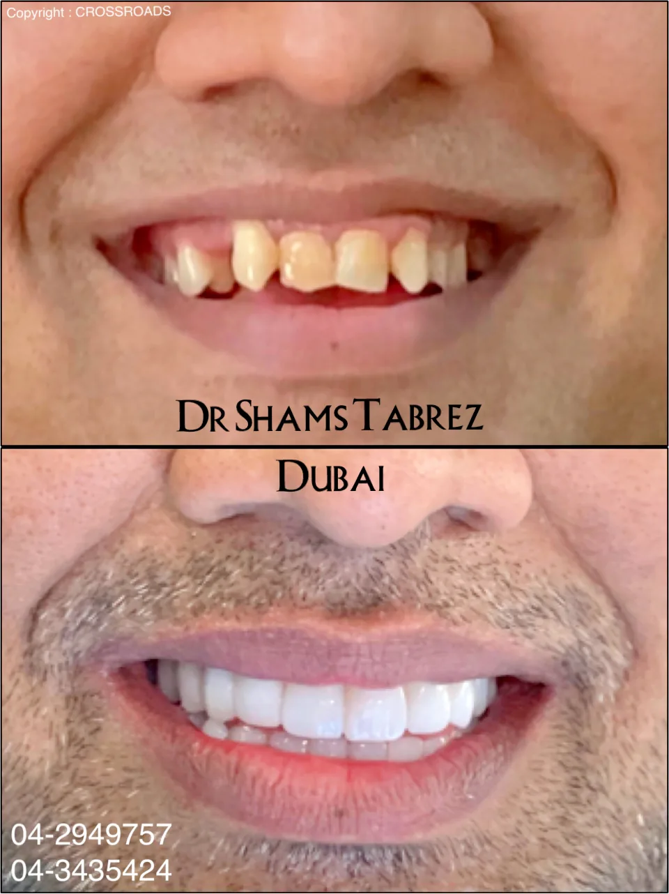 Crossroads Dental Clinic- Best Dental Clinic in Dubai Deira, Dentist near me Veneers, Rct, Invisalign Clear Aligner photo 3