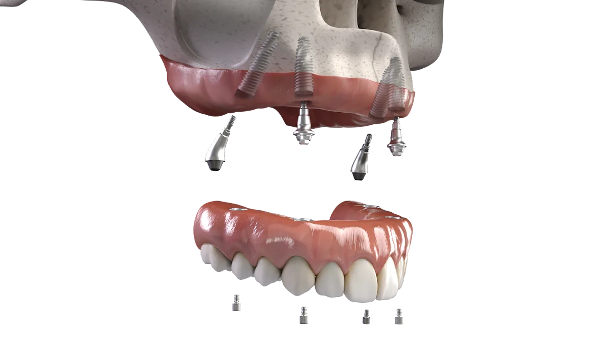 Implant Dental Works photo 4