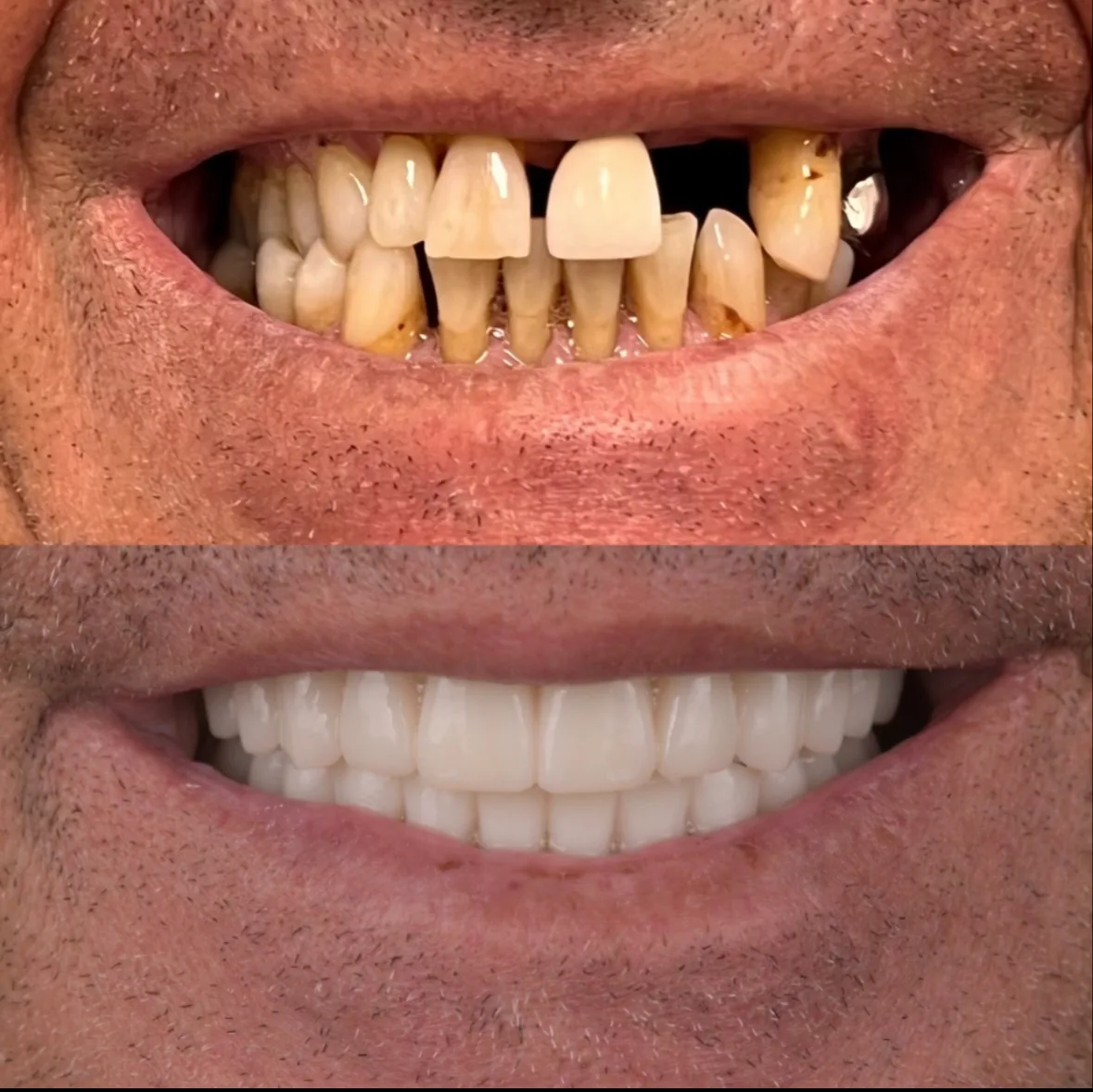 Tampa Dental Implants