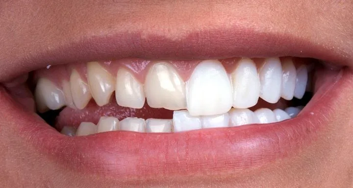 Porcelain Veneers Dental Center Brooklyn | Eco Dental NY photo 3