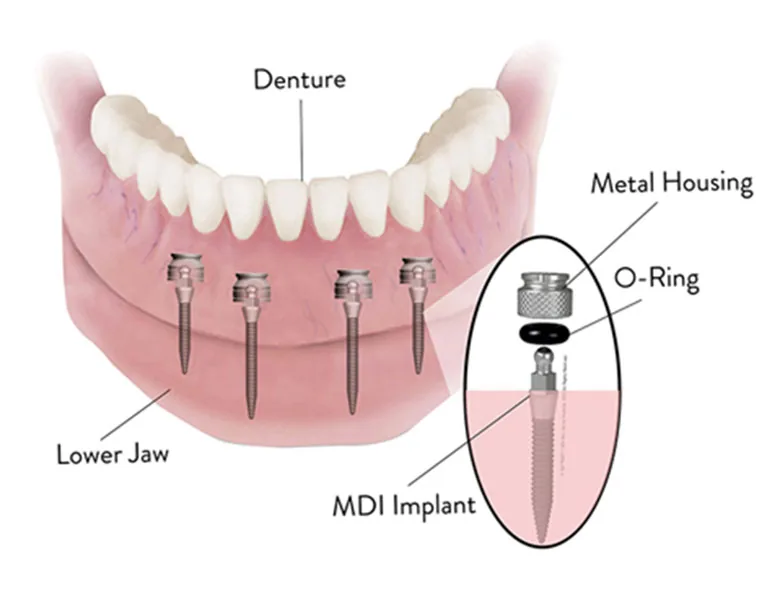 Dental Implant Solutions of Wichita KS photo 5