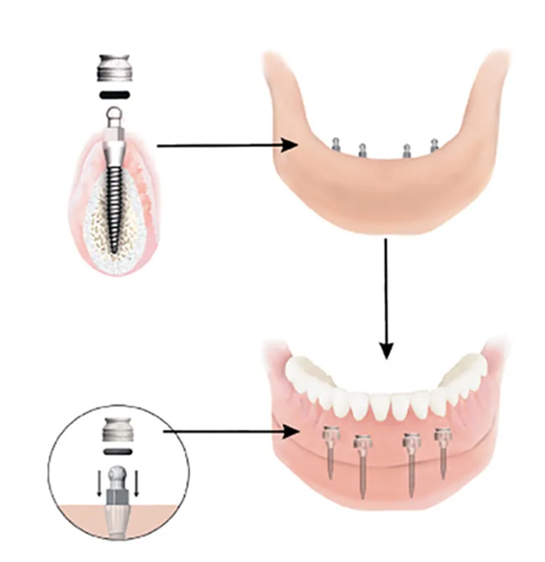 Dental Implant Solutions of Wichita KS photo 4