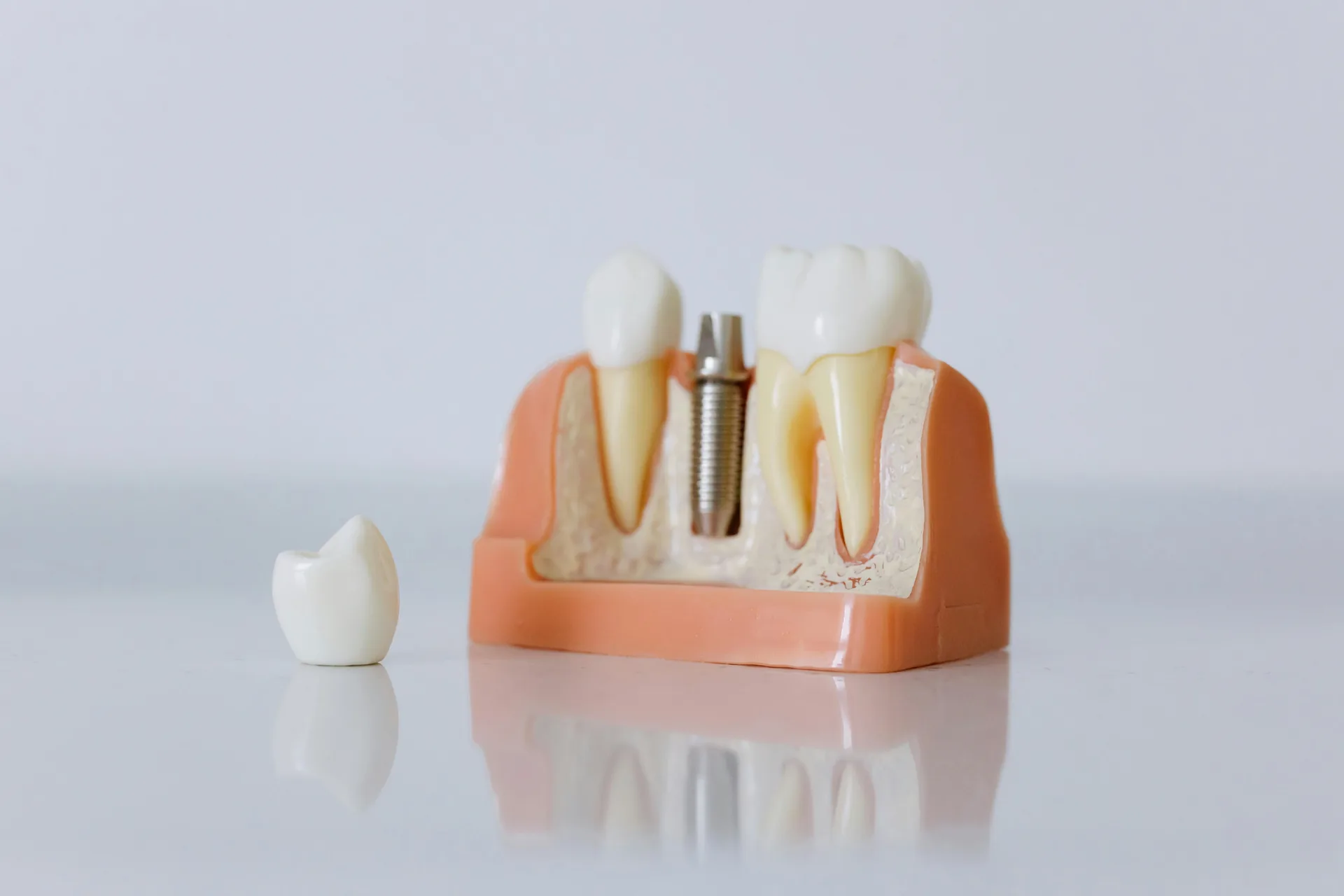 Dental Implants: What You Should Know