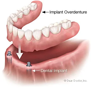 Custom Dentures Lab