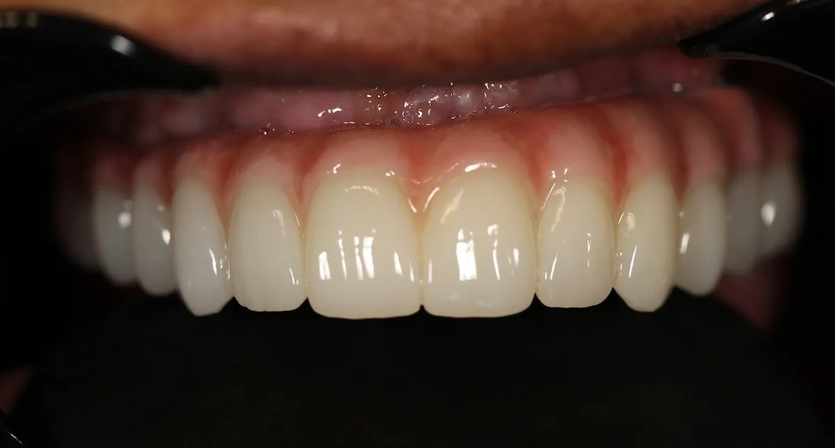 Louisiana Dental Implant Lab