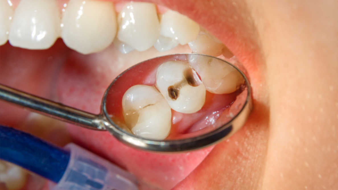 dental cavity