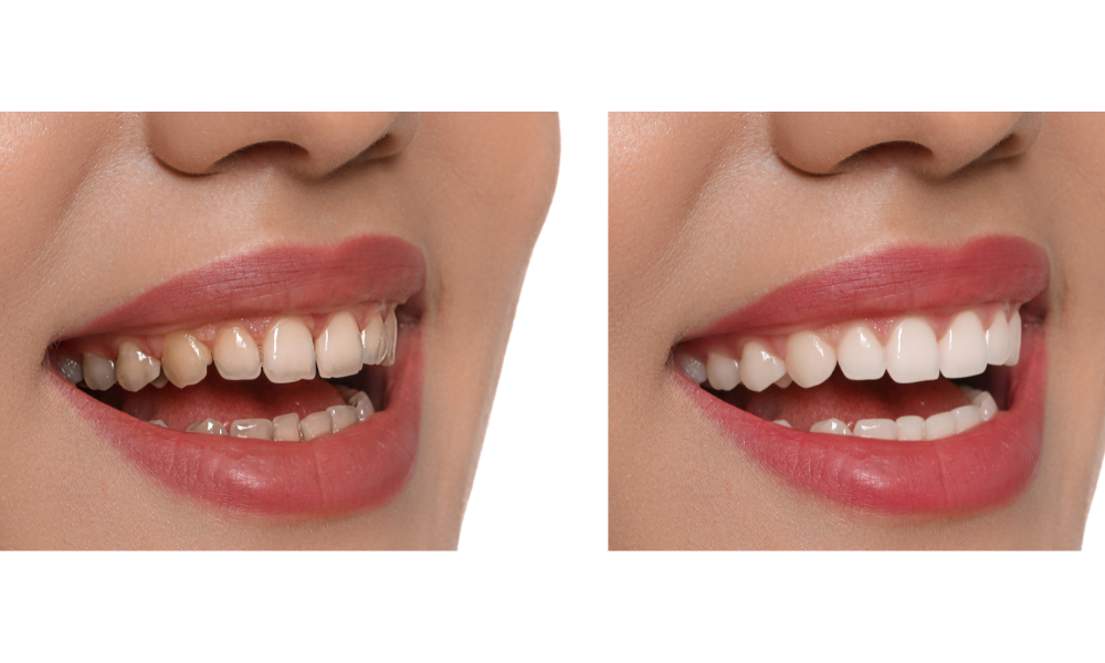 Dental Veneers Post Image