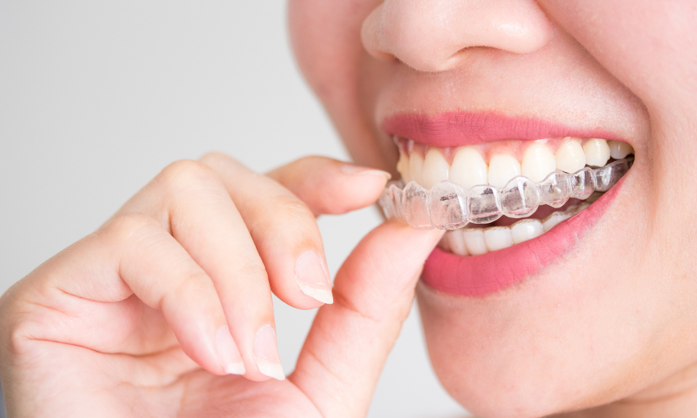 invisalign vs tradional braces post